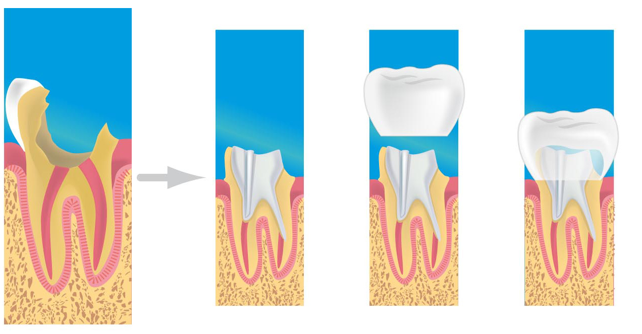prothese dentaire Combs-la-Ville